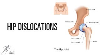 Hip dislocation [upl. by Romain868]