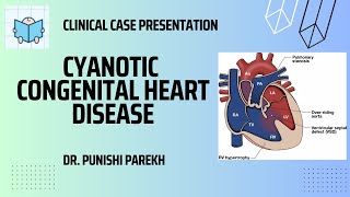 Clinical Case presentation on Cyanotic Congenital Heart disease [upl. by Kcorb]