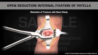 Open Reduction Internal Fixation of Patella [upl. by Koo]