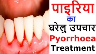 पायरिया के घरेलू उपाय और नुस्खे  Natural Home Remedies amp Treatment for Pyorrhea [upl. by Ennovyhc]