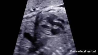 Fetal heart Academy  DORV TGA 1 both outflow tracts from RV 2 [upl. by Derzon]