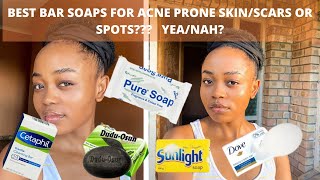 BEST SOAPS FOR MY ACNE PRONE SKIN ACNE SPOT DARK MARKS IMPERFECTIONS 2020 [upl. by Nomor641]