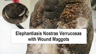 Elephantiasis Nostras Verrucosas and Wound Maggots [upl. by Siuluj681]