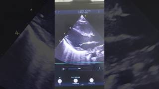 Neonatal Echocardiogram  long axis view showing detailed heart Structure echocardiography [upl. by Letnohc]