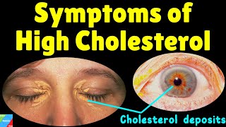 What are the Symptoms of High Cholesterol  What are the Signs of High Cholesterol [upl. by Jen]