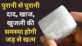 दाद खाज खुजली को जड़ से खत्म करने का 100 घरेलू उपाय  Natural way to get rid of itching  Khujli [upl. by Eilrahc]