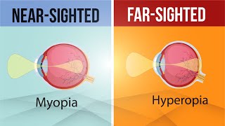 Difference in Myopia and Hyperopia  Nearsighted and FarSighted Lens  Class 10  Letstute CBSE [upl. by Shotton]