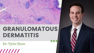 Granulomatous Dermatitis  May 2022 \ Dermpath Happy Hour [upl. by Naoj]