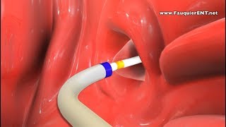 Balloon Eustachian Tube Dilation to Treat Eustachian Tube Dysfunction [upl. by Auqenahc]