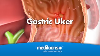 Gastric Ulcer  Meditoons™ [upl. by Nessah]