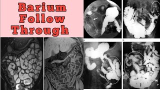 Barium Follow Through Complete Study [upl. by Lovato]