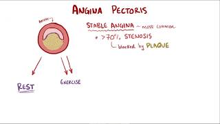 Angina pectoris  stable unstable prinzmetal vasospastic and symptoms [upl. by Eislel]