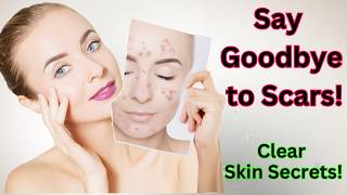 How to Get Rid of Acne Scars Proven Tips for Clear Skin [upl. by Shieh]