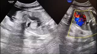 Intracardiac Tumor in fetus during pregnancy 37 weeks Rhabdomyoma [upl. by Ayrad]