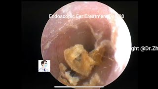 Ear wax removal Cerumen embolization and fungal treatment 12 minutes [upl. by Aleka]