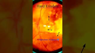 Diabetic retinopathy  Hemorrhages  Hard exudates  Fundus  Short Video 188 [upl. by Joceline]