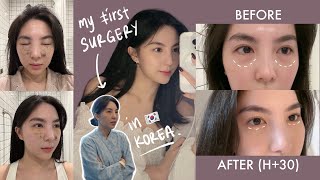 My FIRST SURGERY in Korea 🇰🇷  PRICE  Undereye Fat Removal  VLOG [upl. by Rich454]