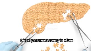 My Distal Pancreatectomy Experience What to Expect [upl. by Adnarem]