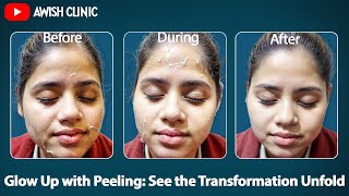 Peeling Procedure Step by Step  Skin peeling Day by Day  Peeling Results by Dr Vijay Kumar [upl. by Clayton]