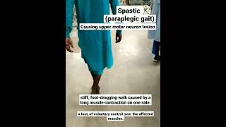 Spastic Paraplegic gait [upl. by Kieryt]