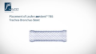 Placement of a Leufen aerstent® TBS [upl. by Ultun60]