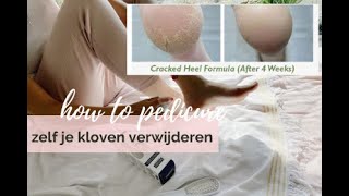 Kloven op je voeten zelf verwijderen en behandelen met de callus softener spray van Footlogix [upl. by Aitnauq]