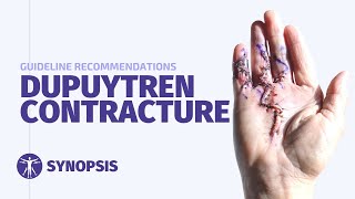 Dupuytrens Contracture Guideline  SYNOPSIS [upl. by Wini328]