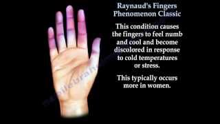 Raynauds Fingers Phenomenon classic  Everything You Need To Know  Dr Nabil Ebraheim [upl. by Samp]