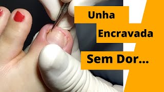 Unha encravada sem dor [upl. by Tebor479]