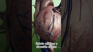 Infarto cardiaco y disección aórtica  Dr William Guerrero medicina shorts [upl. by Sirrap]