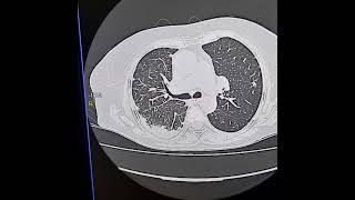 Cryptogenic organising pneumonia [upl. by Jervis]