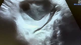 Ultrasound of Bartholin Gland Cyst [upl. by Simpkins]