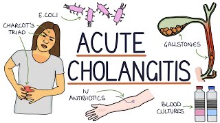 Understanding Acute Cholangitis Ascending Cholangitis [upl. by Jack]