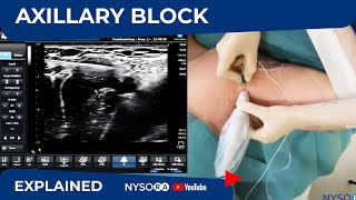 Ultrasound Guided Axillary Brachial Plexus Block NYSORA Regional Anesthesia [upl. by Haididej237]