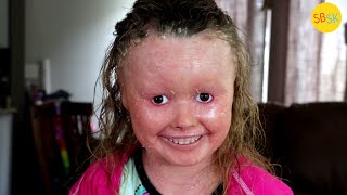 Living with Harlequin Ichthyosis Skin that Grows 10x Too Fast [upl. by Geilich]