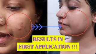 Acne Treatment For PCOS  Natural Home Remedy for PCOD Cystic Acne [upl. by Nauhs]