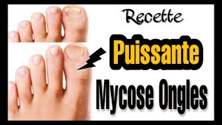 COMMENT JAI SOIGNÉ MA MYCOSE DES ONGLES DE PIED NATURELLEMENT Vie Saine [upl. by Mccall]