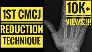 1st CMCJ Carpometacarpal JointReduction Technique [upl. by Anirdnajela]