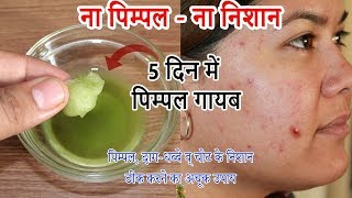 पुराने से पुराने पिम्पल्सदागधब्बे व किसी भी तरह के निशान हटाए  Remove Pimple  Acne Treatment [upl. by Sallie]