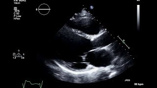 Ischemic Cardiomyopathy 2D Echocardiogram [upl. by Notxed]