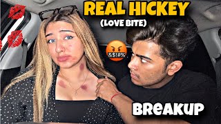 Real Hickey Love Bite 💋 Prank On Anmol  He Got Extremely Angry 🤬 [upl. by Brandie]