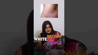 Can Stretch Marks Be Treated Here’s What You Need to Know  DrRadha Dermatology [upl. by Aehcsrop]