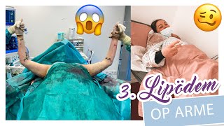 3 LIPÖDEM OPERATION  ARME  Erste VOLLNARKOSE Liposuktion Heilung Kosten etc  YooNessa [upl. by Llennyl]