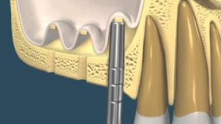 soulevé de sinus par voie crestale summers avec pose de 3 implants [upl. by Sylvanus]