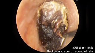 Easy earwax removal简单的耳屎清理20230903 [upl. by Aoniak]