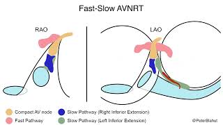 AVNRT SlowFast FastSlow SlowSlow  Ablation Targets [upl. by Vaughn403]