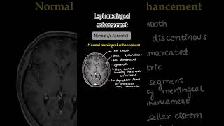 Leptomeningeal enhancement Full video on our channelXrayusg mri brain neuroimaging neetpg [upl. by Eelsel]