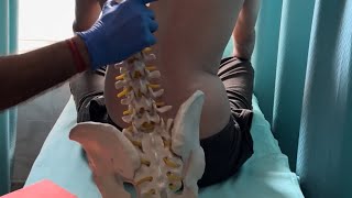 Posture correction in scoliosis patient by DrRavi [upl. by Violante]