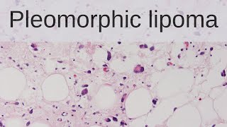 Pleomorphic Lipoma  Pathology mini tutorial [upl. by Sikram]