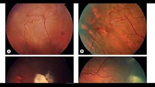 Kanski clinical Ophthalmology Made Easy  Retina 6 [upl. by Ynettirb]